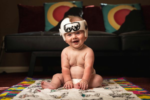 Plagiocephaly